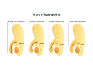 Hypospadias