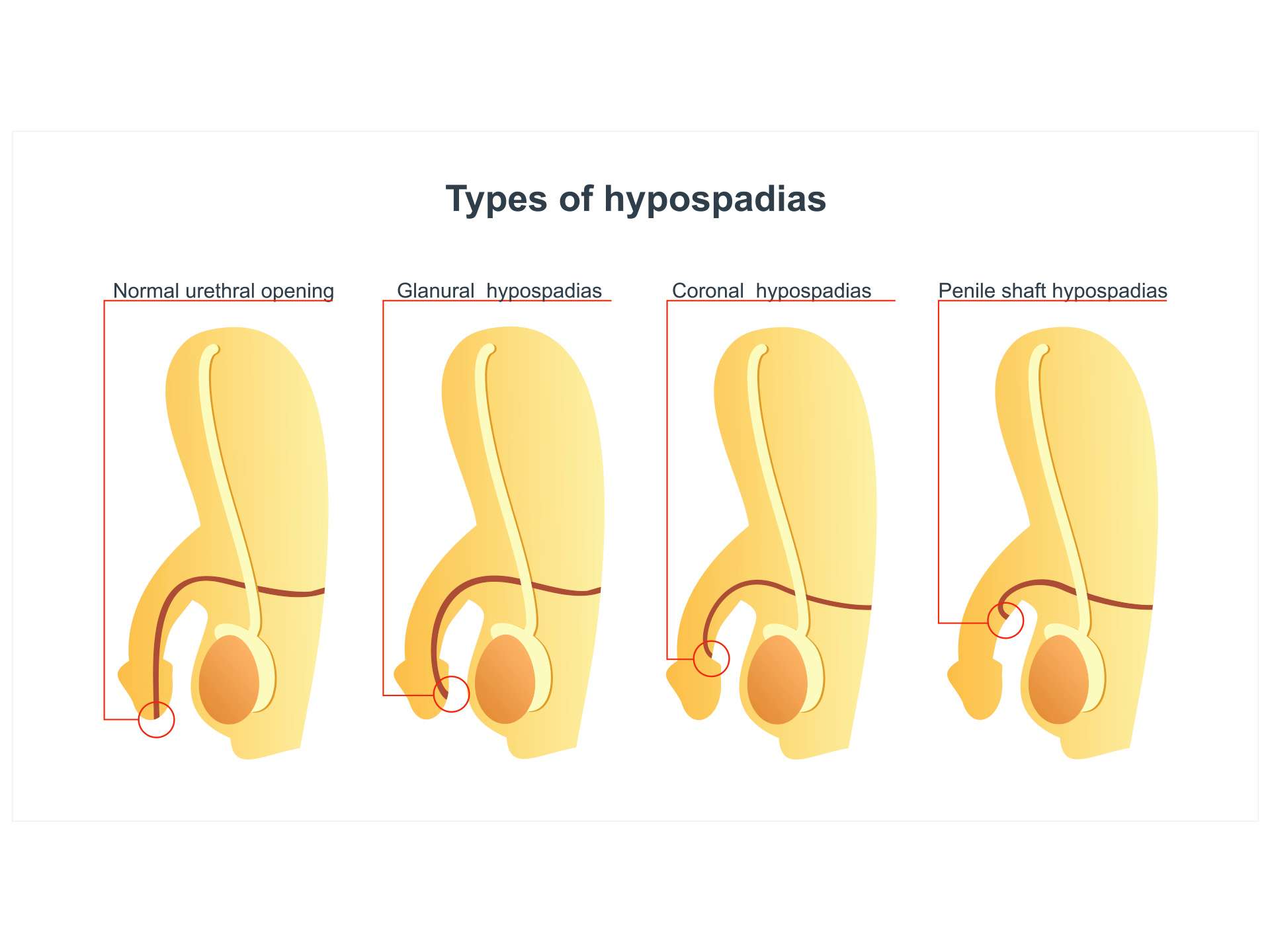 Hypospadias