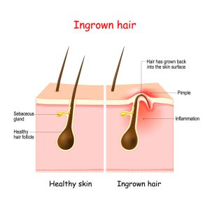 Ingrown hair