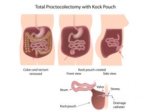 Intestinal Obstruction