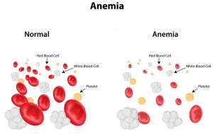 Iron deficiency anemia