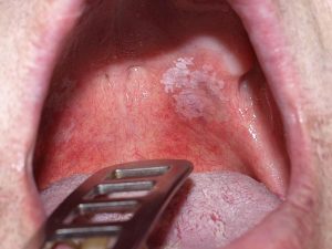 Leukoplakia