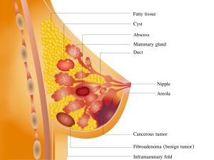 Mammary duct ectasia