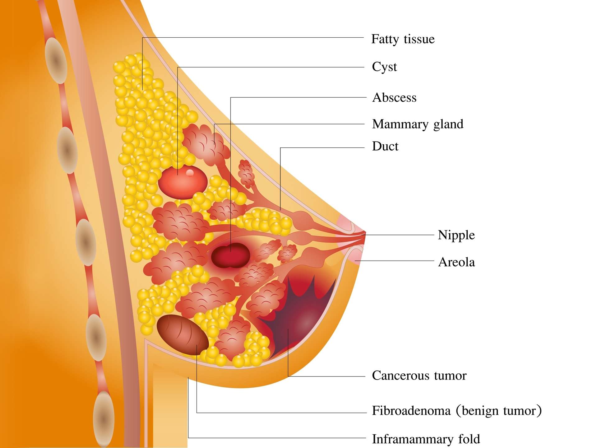 Mammary duct ectasia