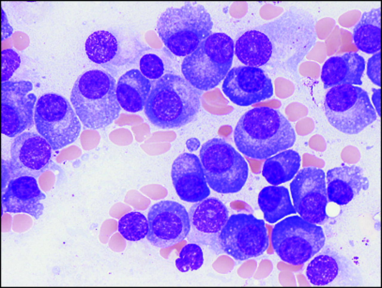 Multiple myeloma