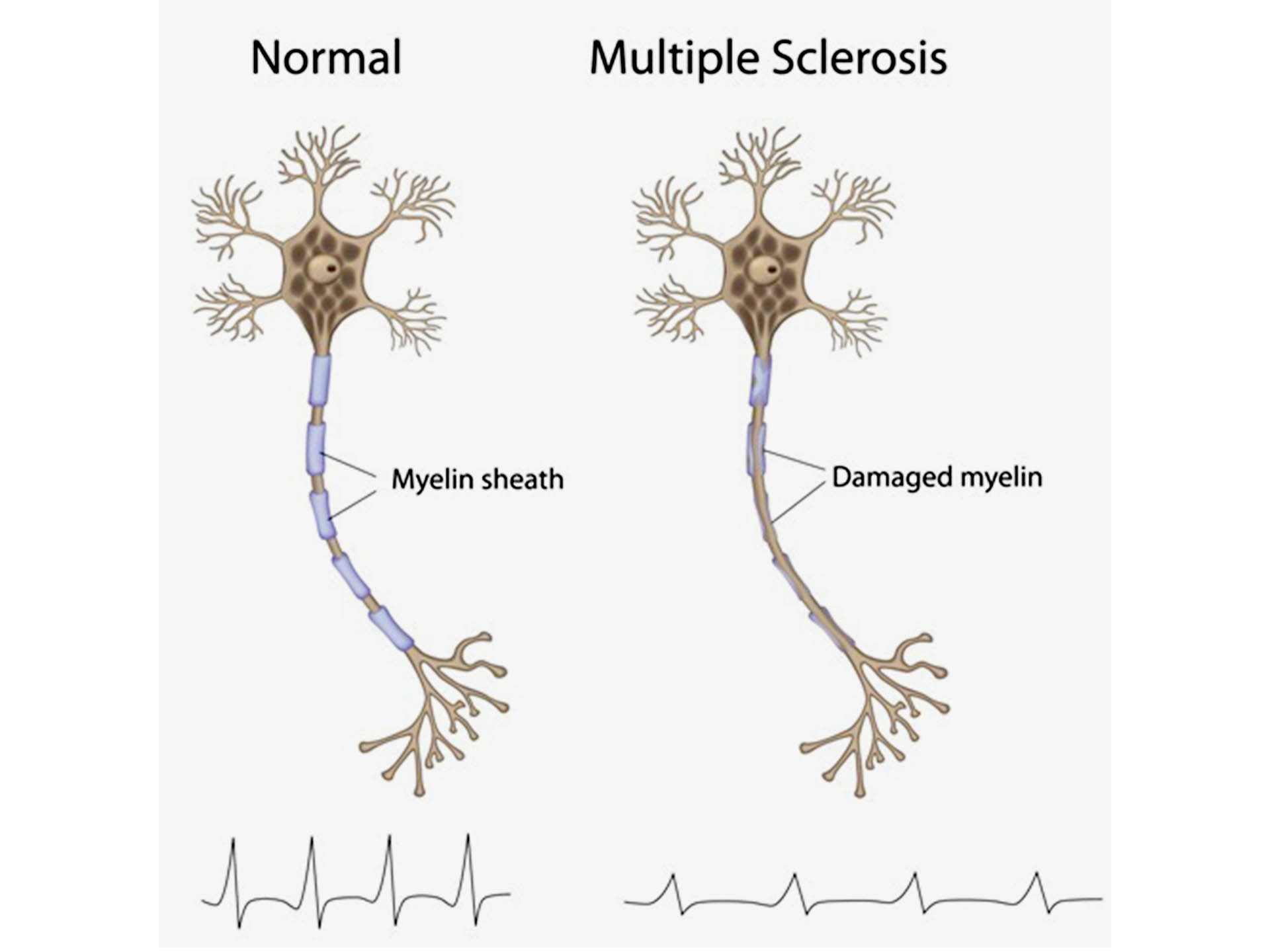 Multiple sclerosis