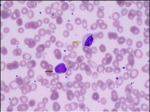 Myelodysplastic syndrome