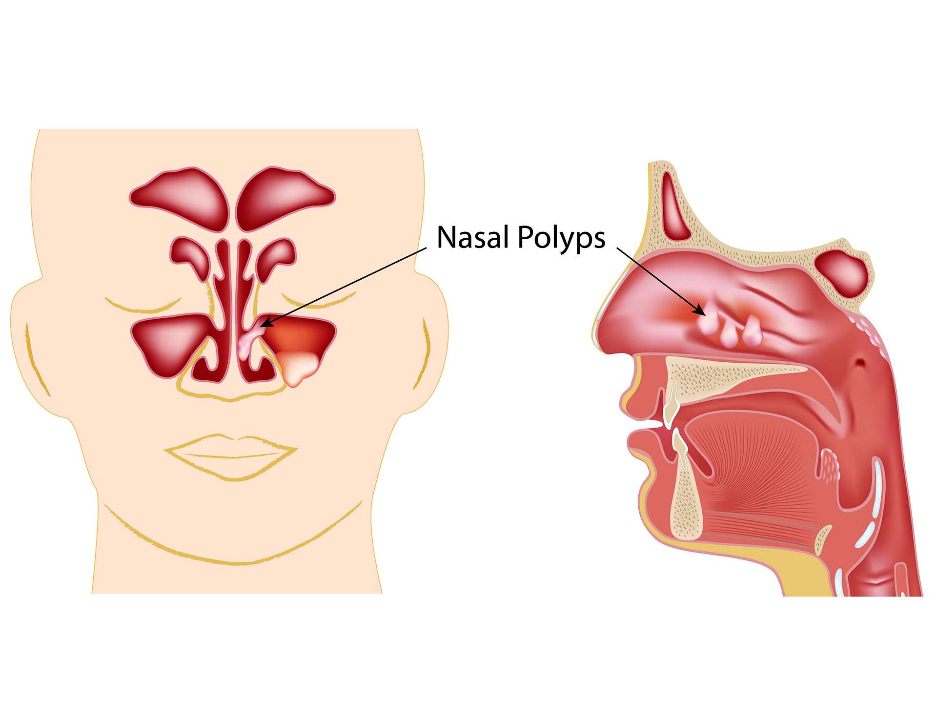 Nasal polyps