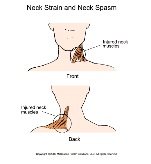 Neck Sprain