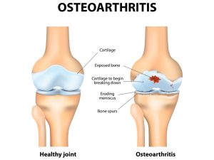 Osteoarthritis