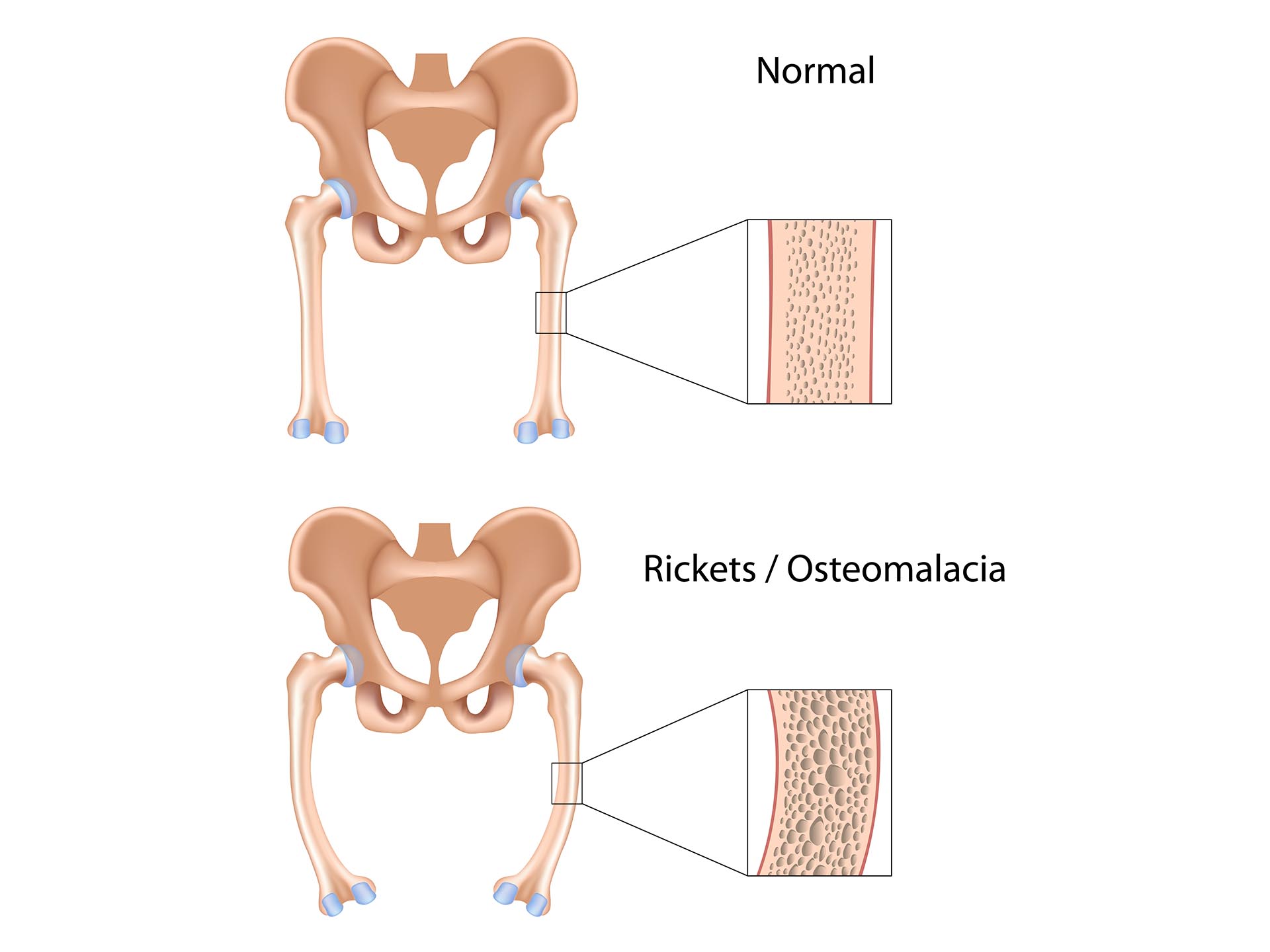 Osteomalacia