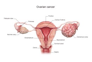 Ovarian cancer