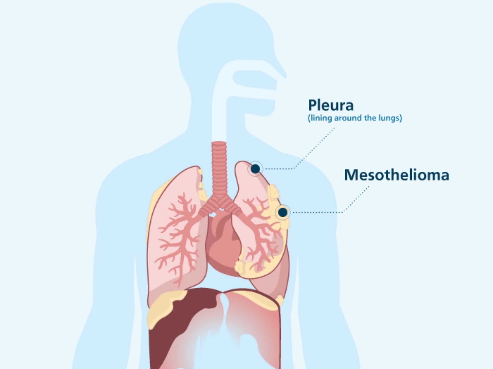 PLEURA