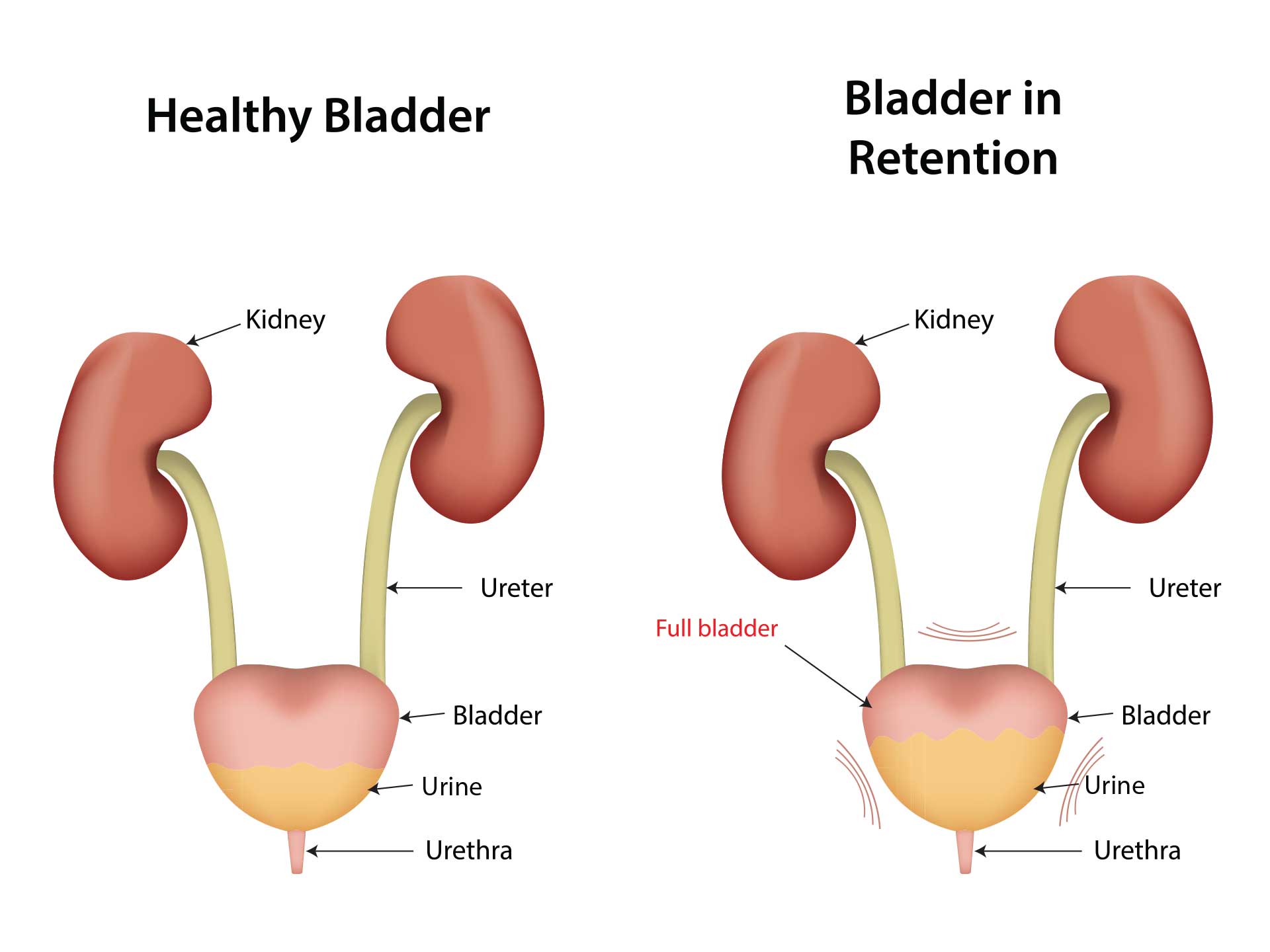 Retention of urine