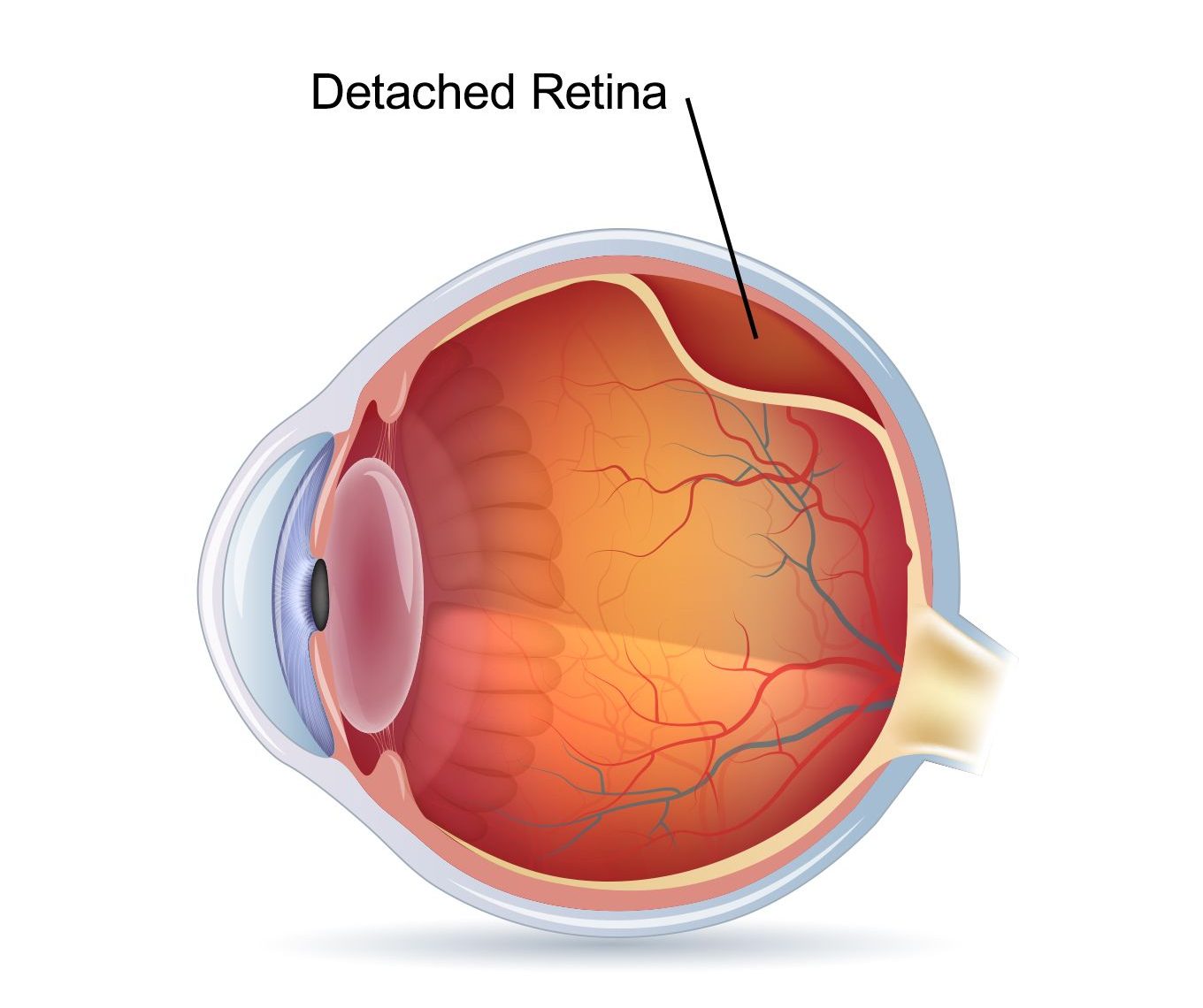 Retinal detachment