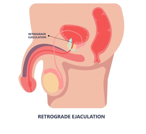 Retrograde ejaculation