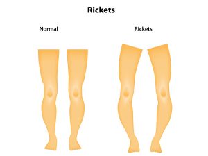 Rickets