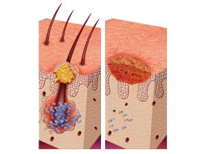 Scalp folliculitis