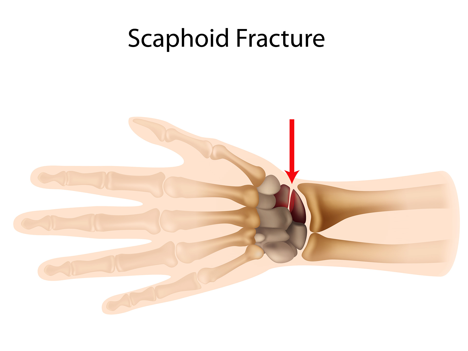 Scaphoid Fracture