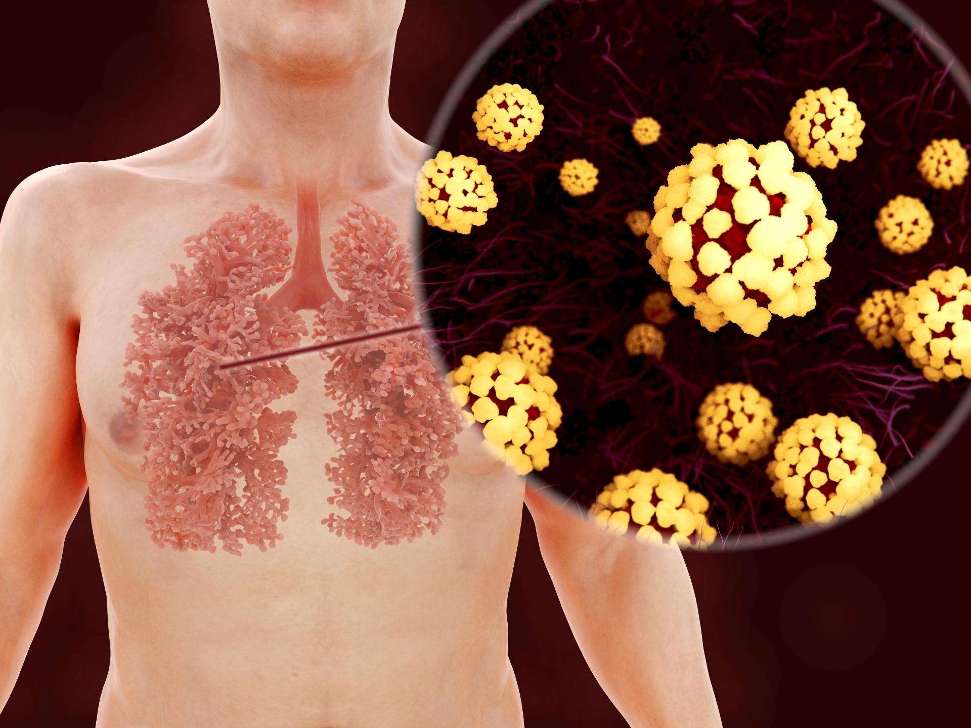 Severe acute respiratory syndrome (SARS)