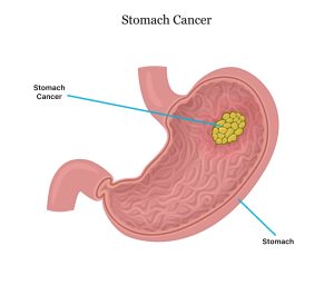 Stomach Cancer