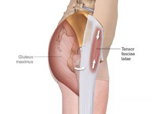 TENSOR FASCIA LATAE