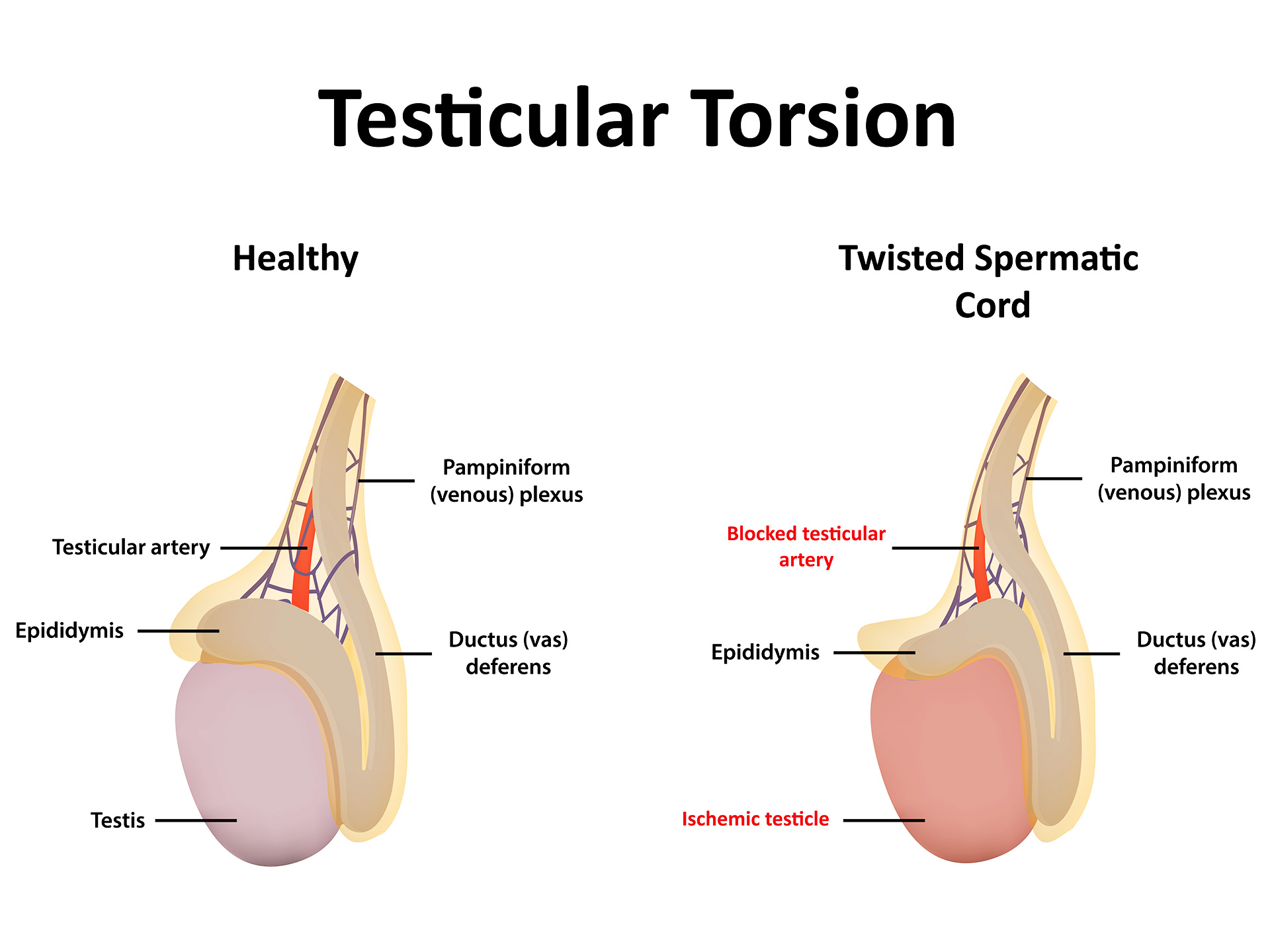 Testicular Torsion