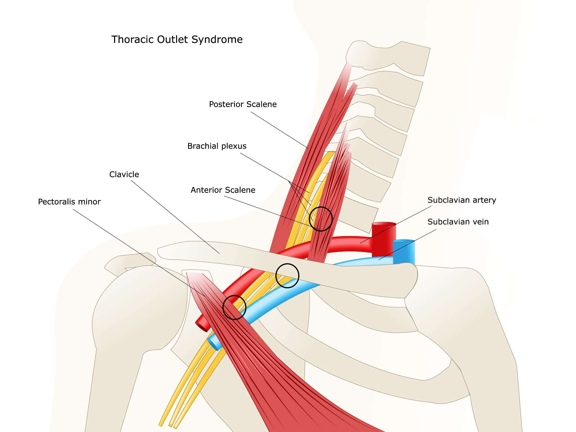 Thoracic outlet syndrome