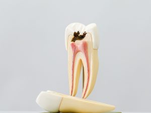 Tooth decay