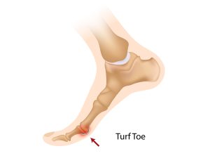 Turf Toe