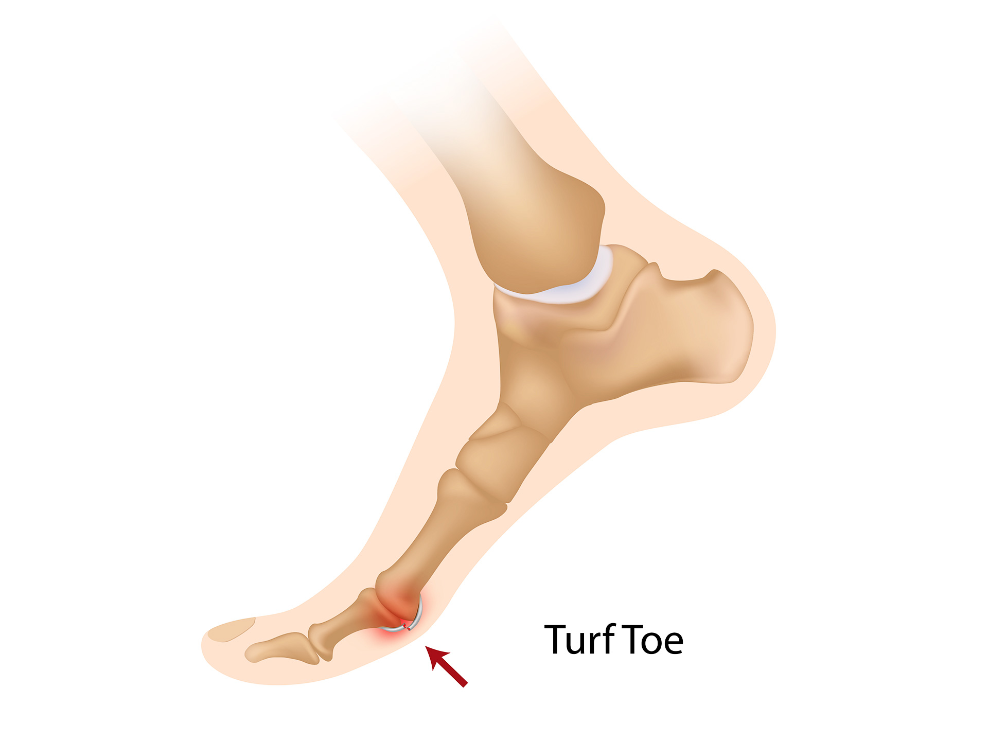 Turf Toe