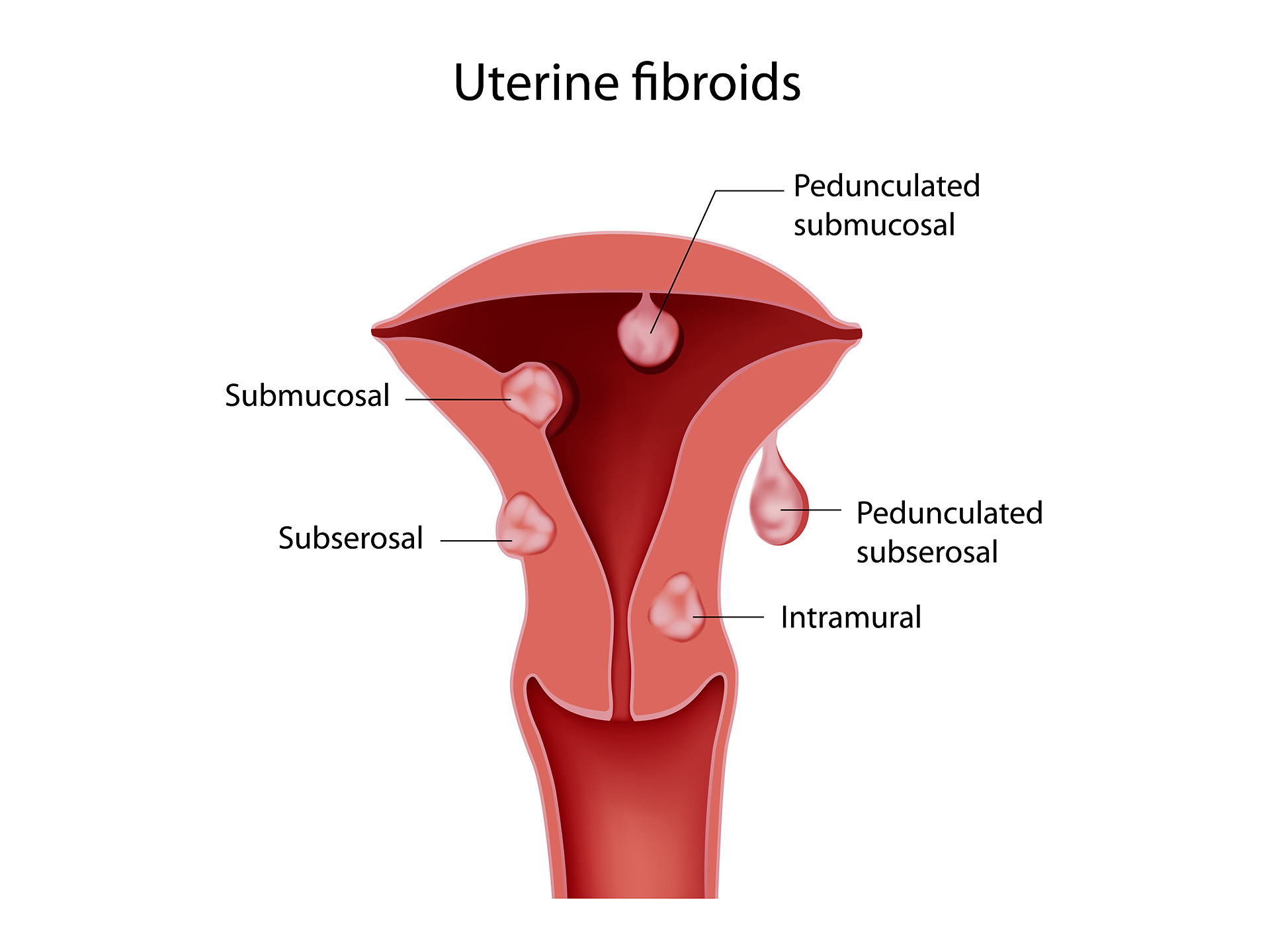 Uterine fibroids