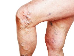 Varicose veins