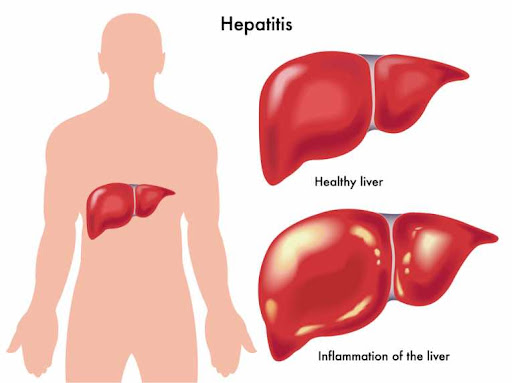 Viral Hepatitis