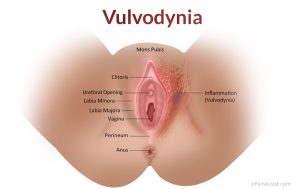 Vulvodynia