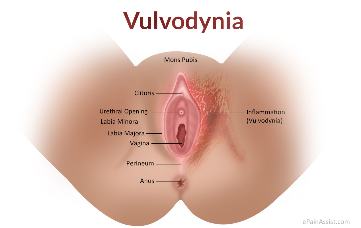 Vulvodynia