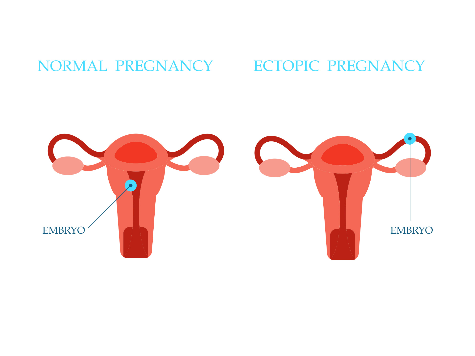 Ectopic pregnancy