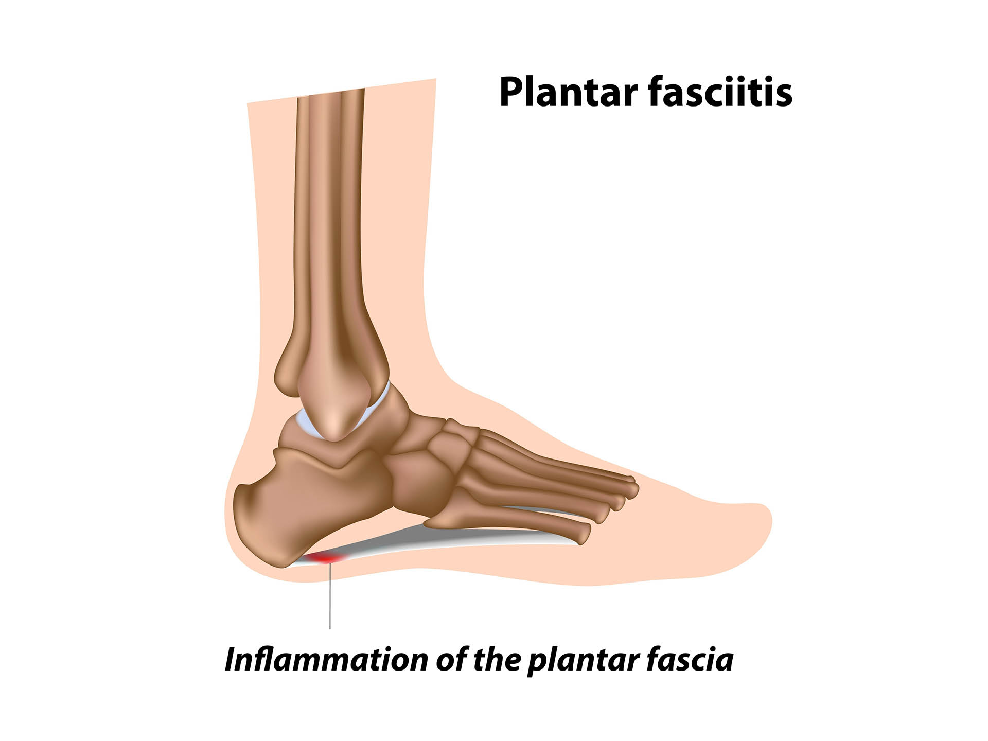 Plantar fasciitis