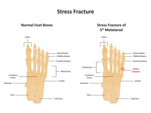 Stress Fracture