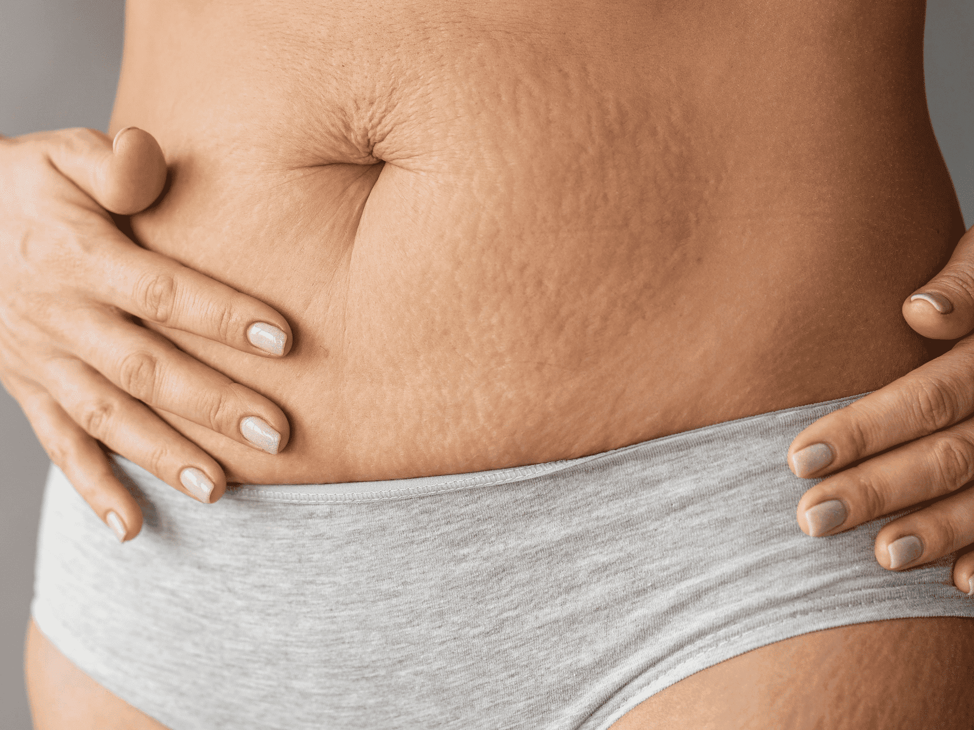 Stretch marks – Why me?