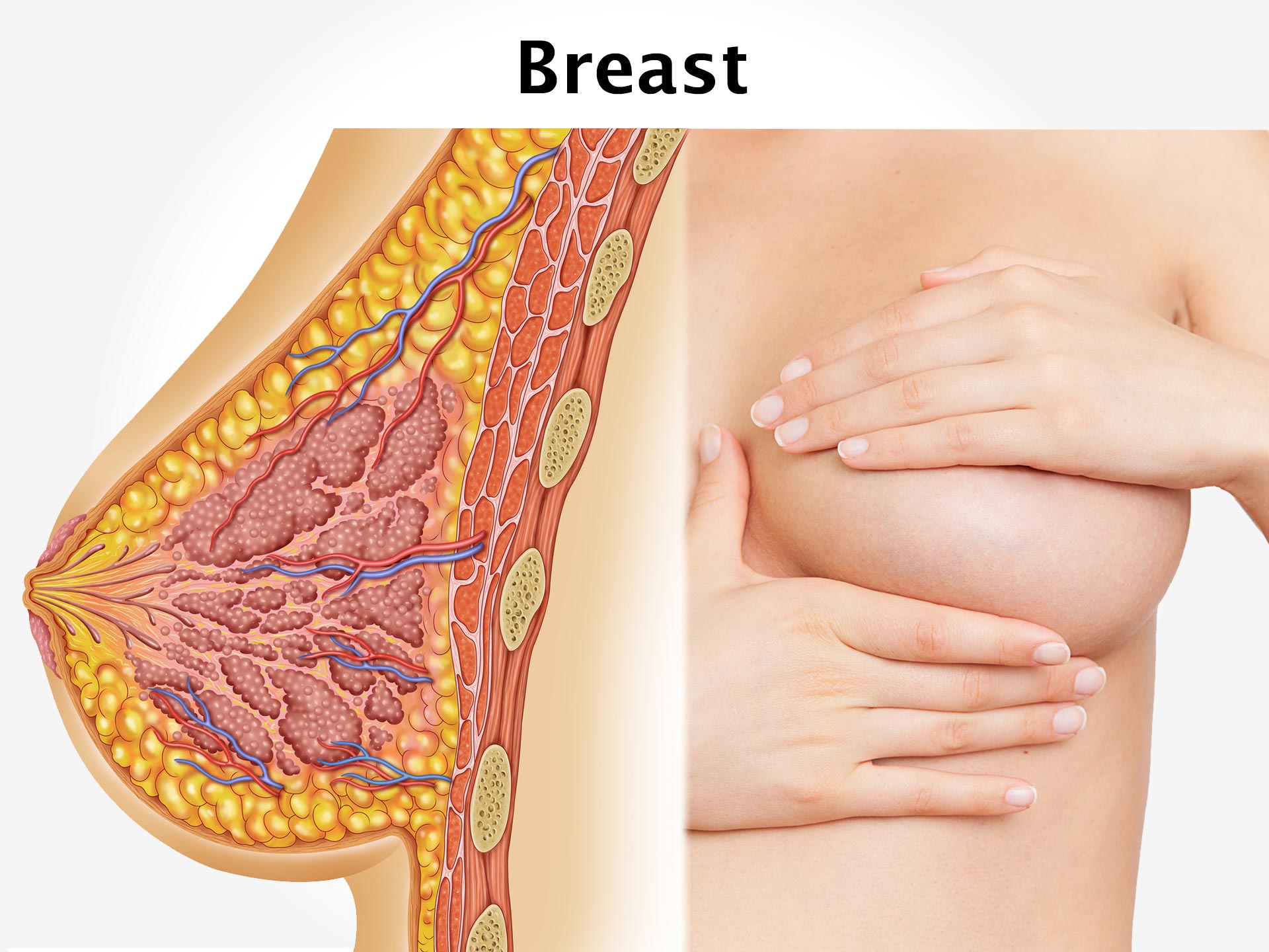 A Typical Hyperplasia Of The Breast