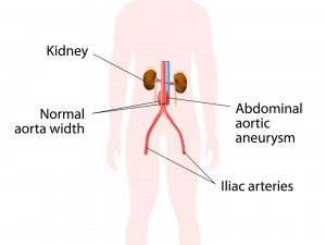 Abdominal Aortic Aneurysm