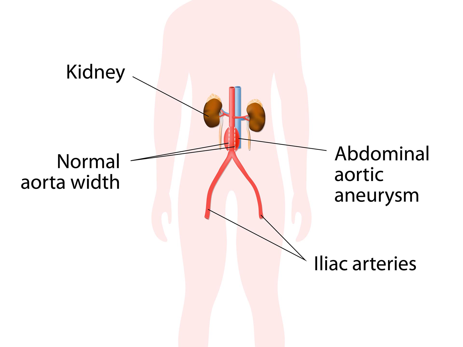 Abdominal Aortic Aneurysm