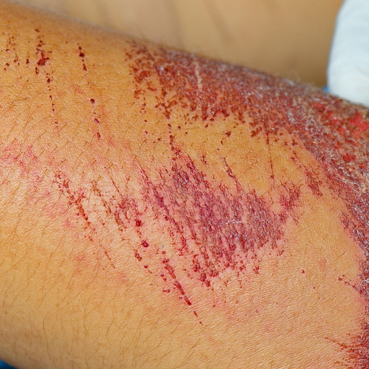 Abrasion (Skin)