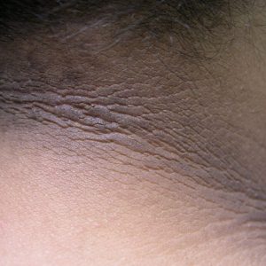 Acanthosis Nigricans