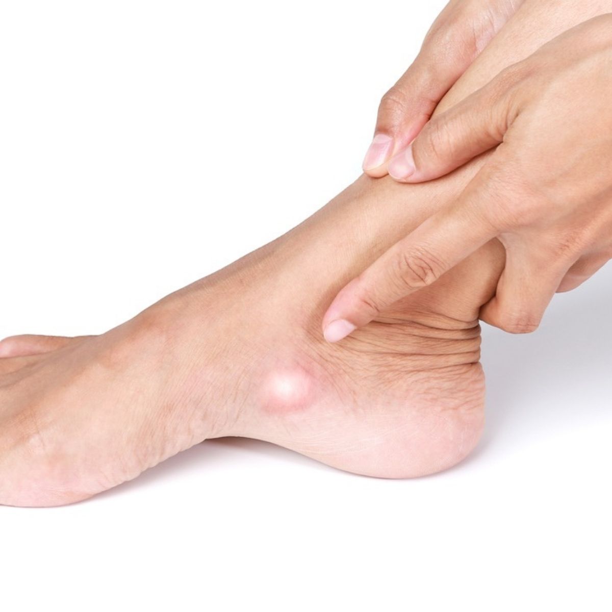 Accessory Navicular Syndrome