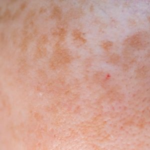 Achromic Nevus