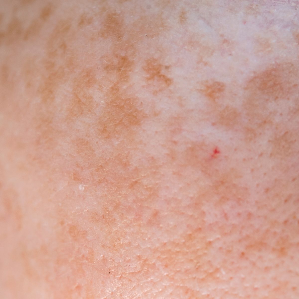 Achromic Nevus