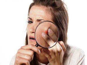 Acne treatment- Common mistakes