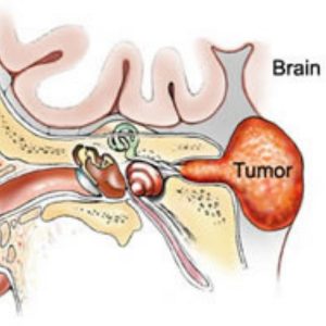 Acoustic Neuroma